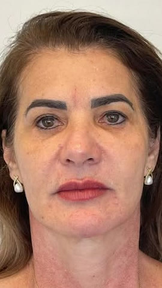 Depois: rejuvenescimento com o protocolo Lumière Face.